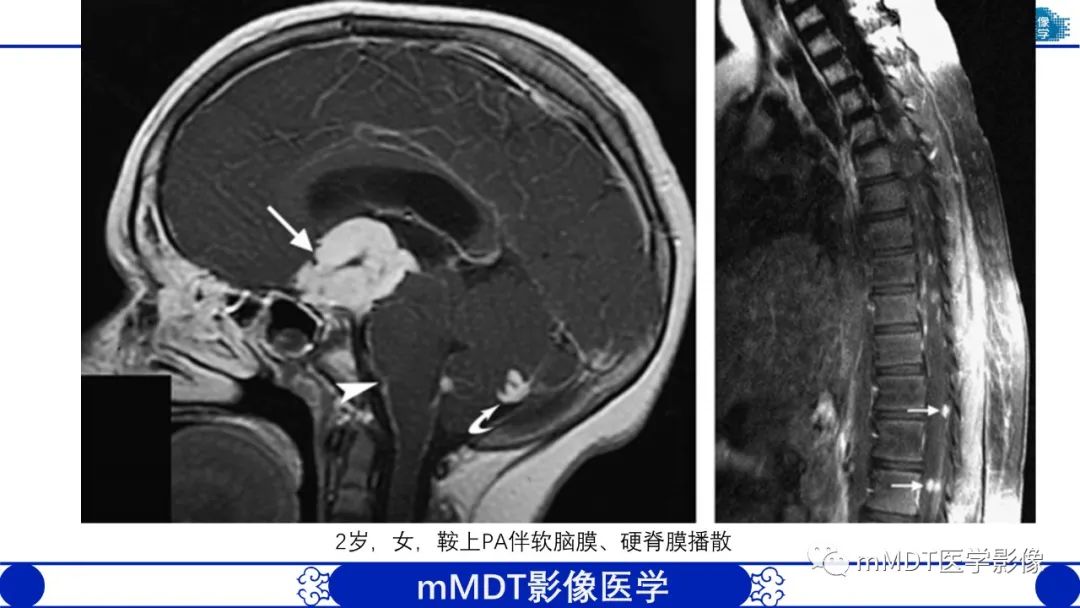 影像PPT - 【病例】脑室内毛细胞星形细胞瘤伴室管膜下转移1例MR影像-55