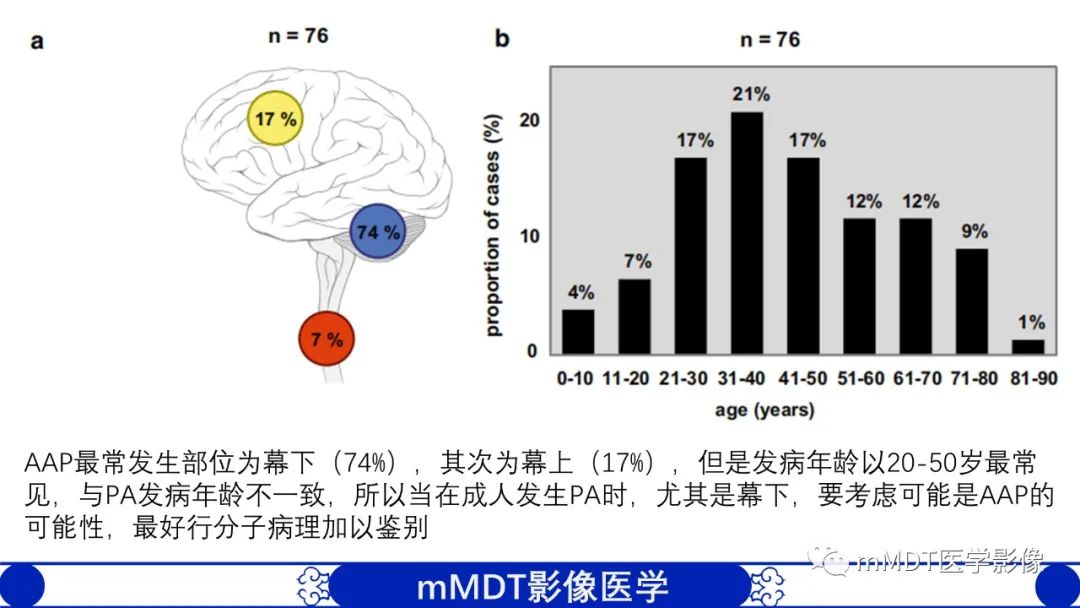 影像PPT - 【病例】脑室内毛细胞星形细胞瘤伴室管膜下转移1例MR影像-62