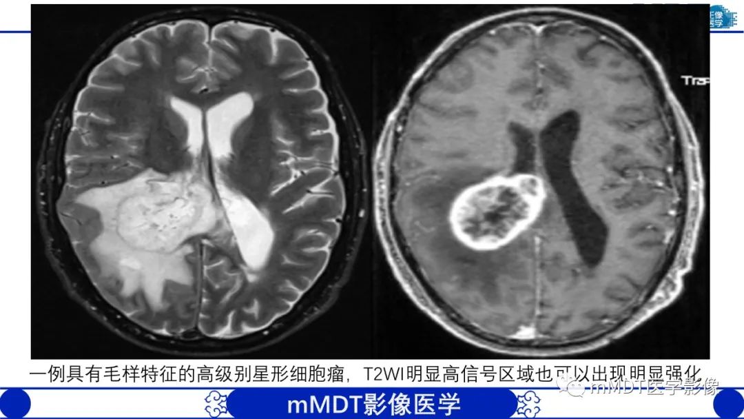 影像PPT - 【病例】脑室内毛细胞星形细胞瘤伴室管膜下转移1例MR影像-63