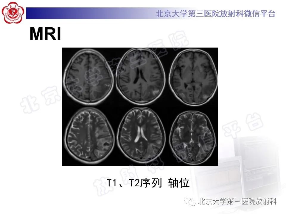 影像PPT - 【PPT】脑膜转移瘤-4