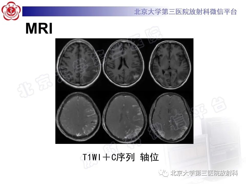 影像PPT - 【PPT】脑膜转移瘤-5