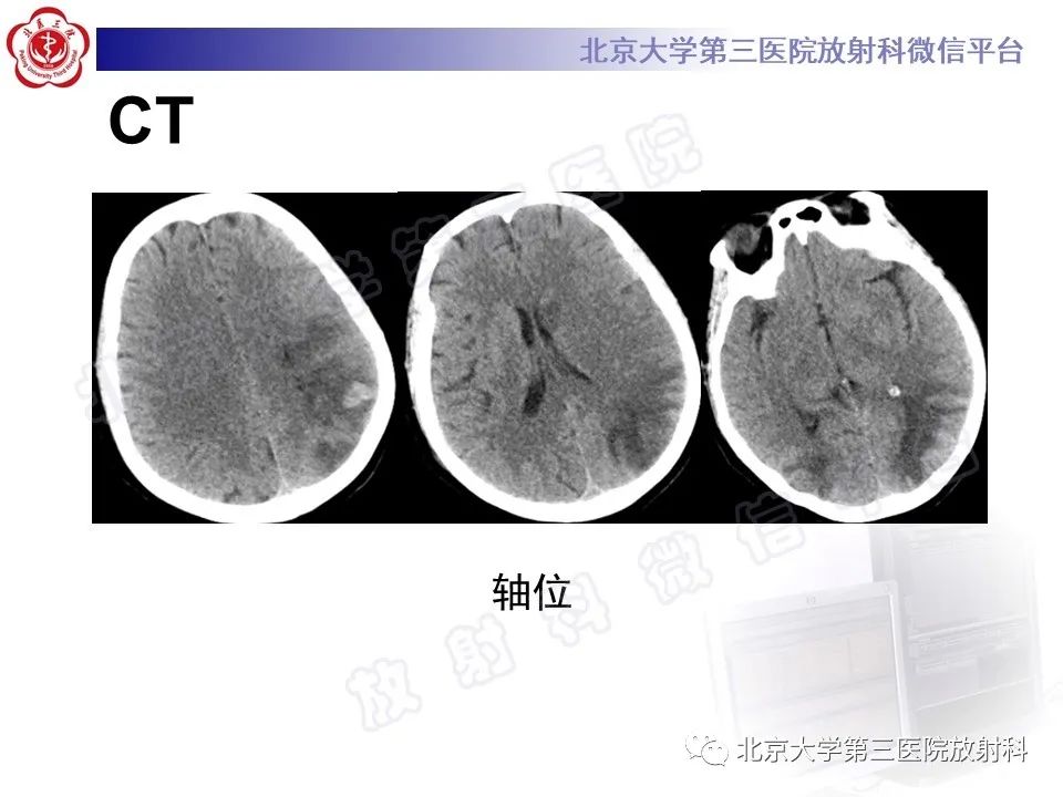 影像PPT - 【PPT】脑膜转移瘤-3
