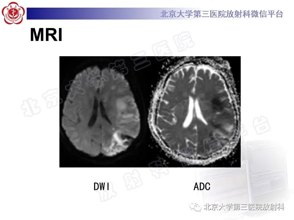 影像PPT - 【PPT】脑膜转移瘤-6