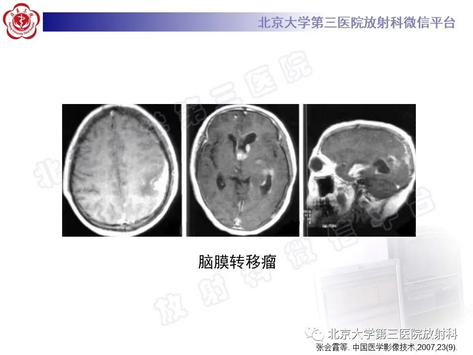 影像PPT - 【PPT】脑膜转移瘤-17