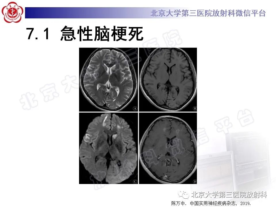 影像PPT - 【PPT】脑膜转移瘤-22