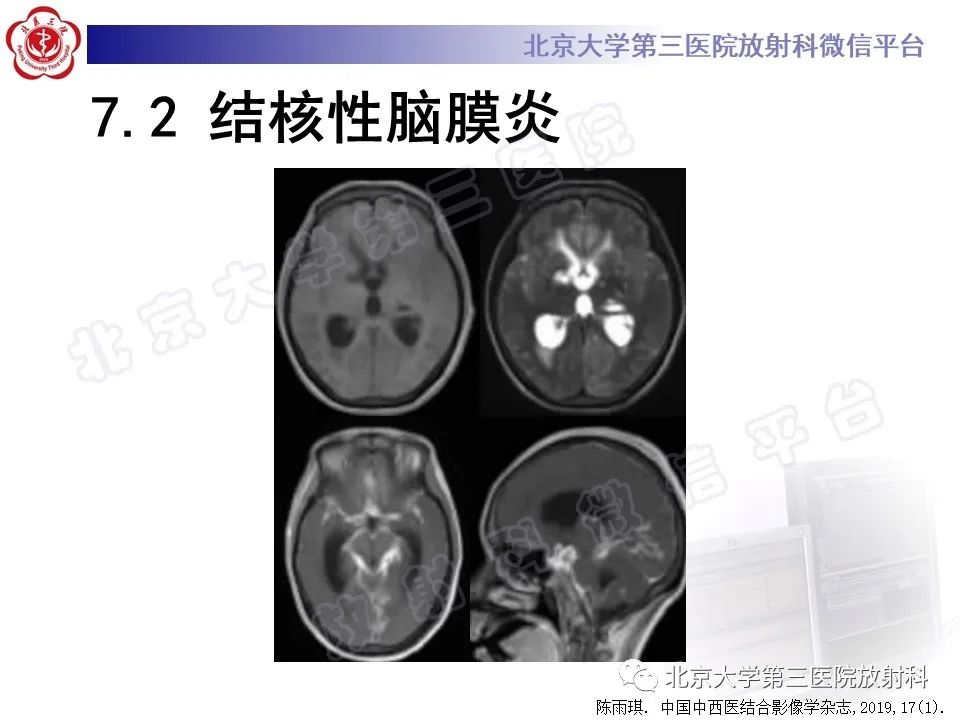影像PPT - 【PPT】脑膜转移瘤-25