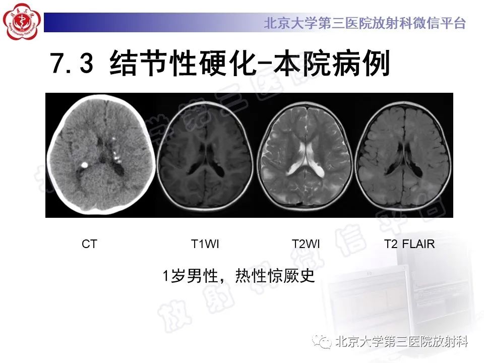 影像PPT - 【PPT】脑膜转移瘤-29