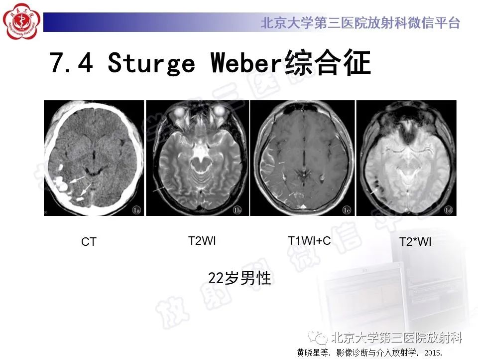 影像PPT - 【PPT】脑膜转移瘤-32