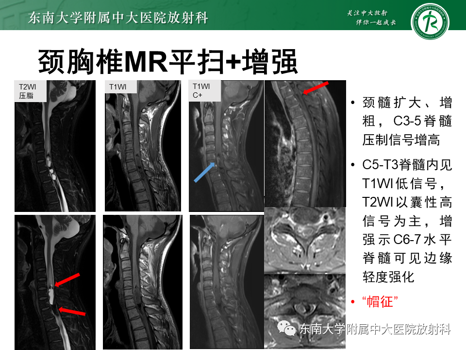 影像PPT - 【PPT】脊髓室管膜瘤-6 影像PPT - 【PPT】脊髓室管膜瘤-6