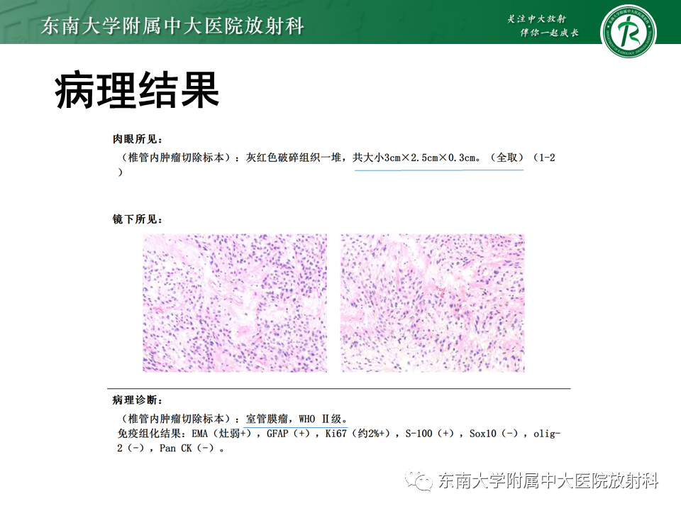 影像PPT - 【PPT】脊髓室管膜瘤-8 影像PPT - 【PPT】脊髓室管膜瘤-8