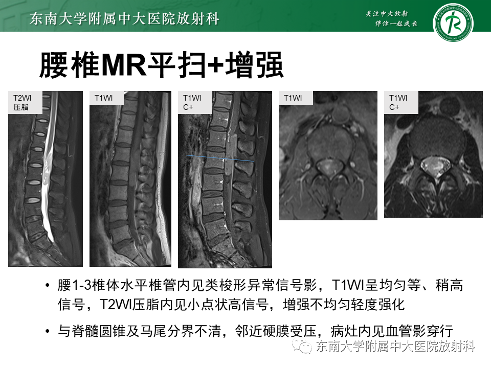 影像PPT - 【PPT】脊髓室管膜瘤-10 影像PPT - 【PPT】脊髓室管膜瘤-10