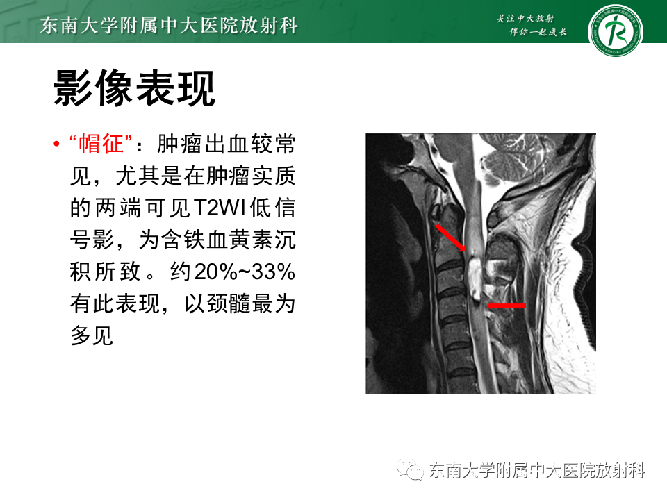 影像PPT - 【PPT】脊髓室管膜瘤-14 影像PPT - 【PPT】脊髓室管膜瘤-14