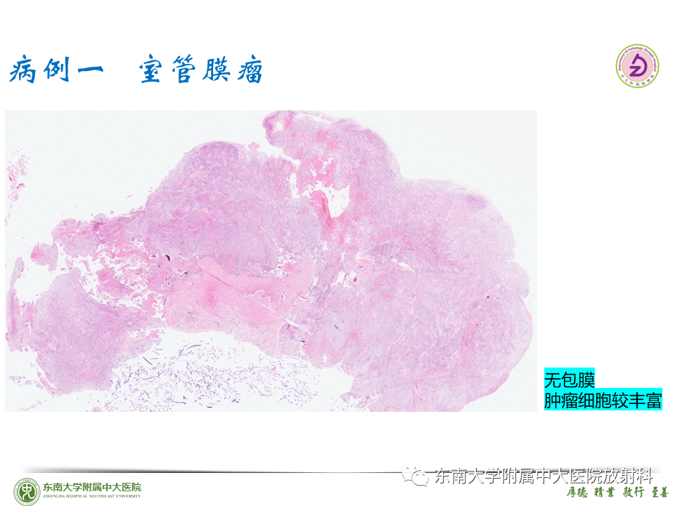 影像PPT - 【PPT】脊髓室管膜瘤-21 影像PPT - 【PPT】脊髓室管膜瘤-21