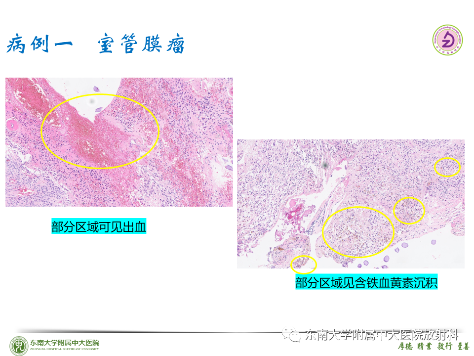 影像PPT - 【PPT】脊髓室管膜瘤-23 影像PPT - 【PPT】脊髓室管膜瘤-23