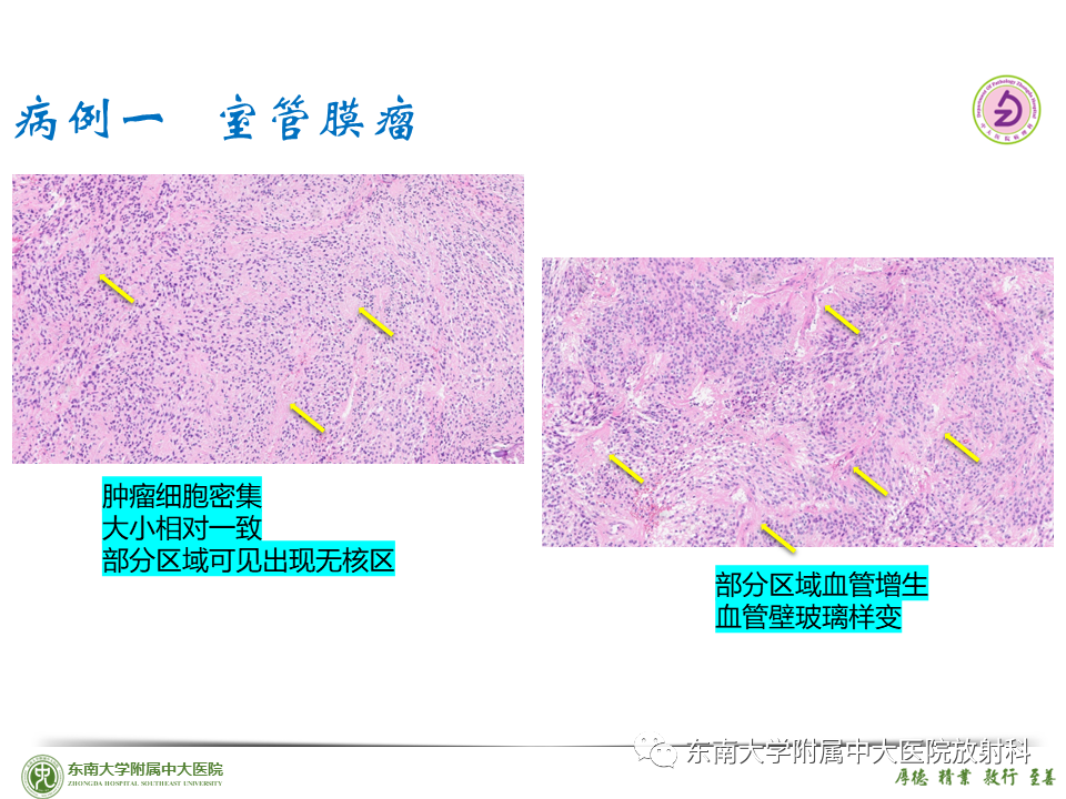 影像PPT - 【PPT】脊髓室管膜瘤-22 影像PPT - 【PPT】脊髓室管膜瘤-22