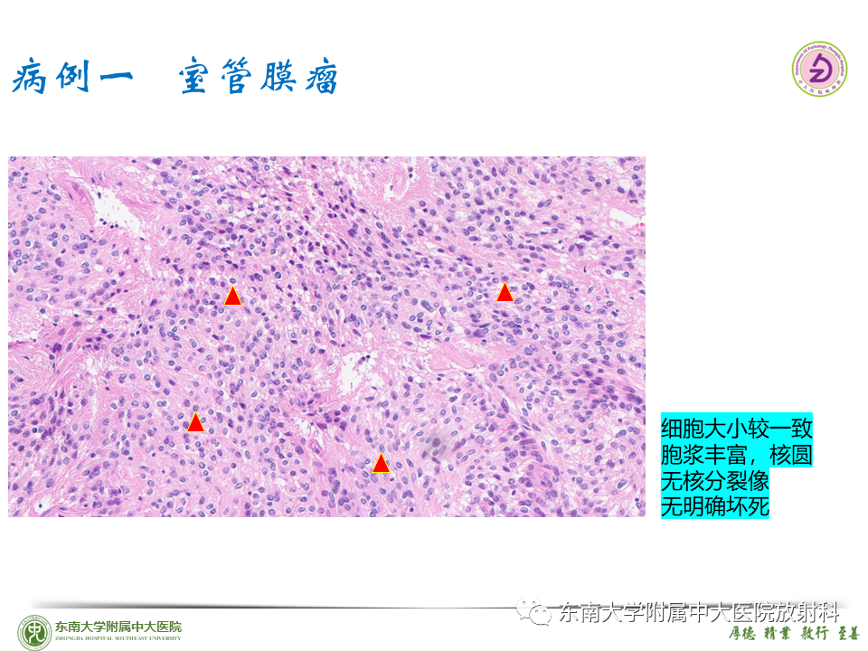 影像PPT - 【PPT】脊髓室管膜瘤-24 影像PPT - 【PPT】脊髓室管膜瘤-24