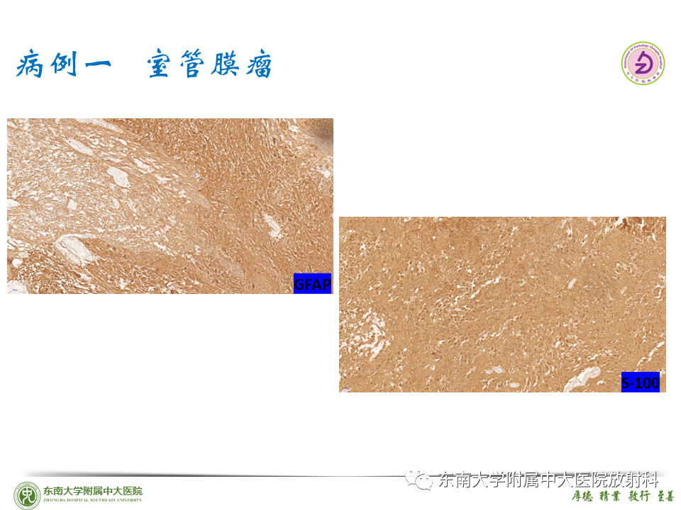 影像PPT - 【PPT】脊髓室管膜瘤-25 影像PPT - 【PPT】脊髓室管膜瘤-25