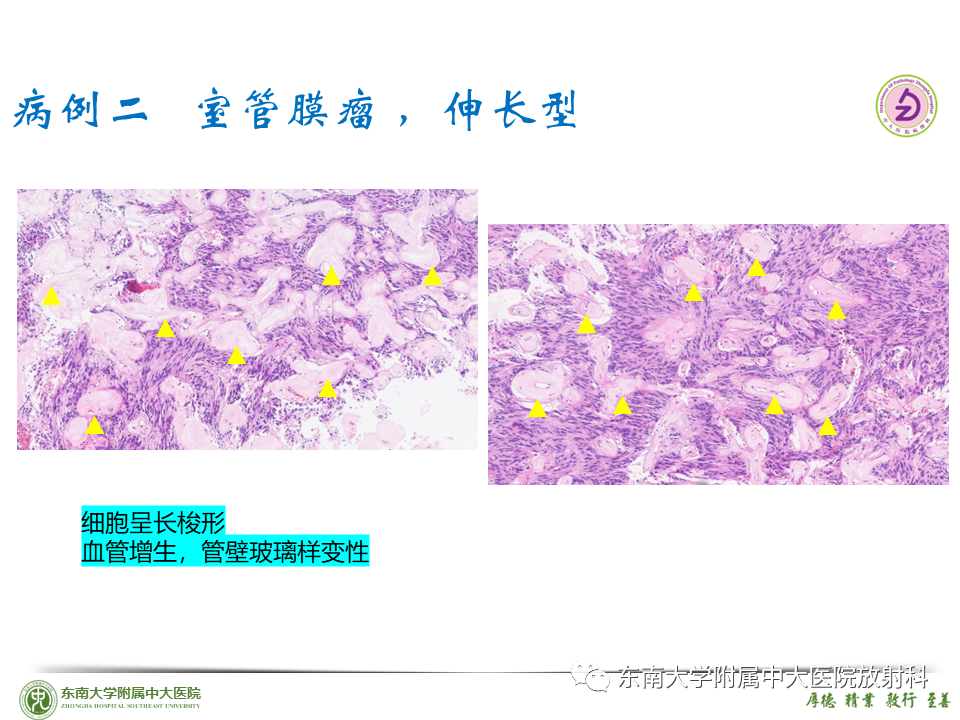 影像PPT - 【PPT】脊髓室管膜瘤-29 影像PPT - 【PPT】脊髓室管膜瘤-29