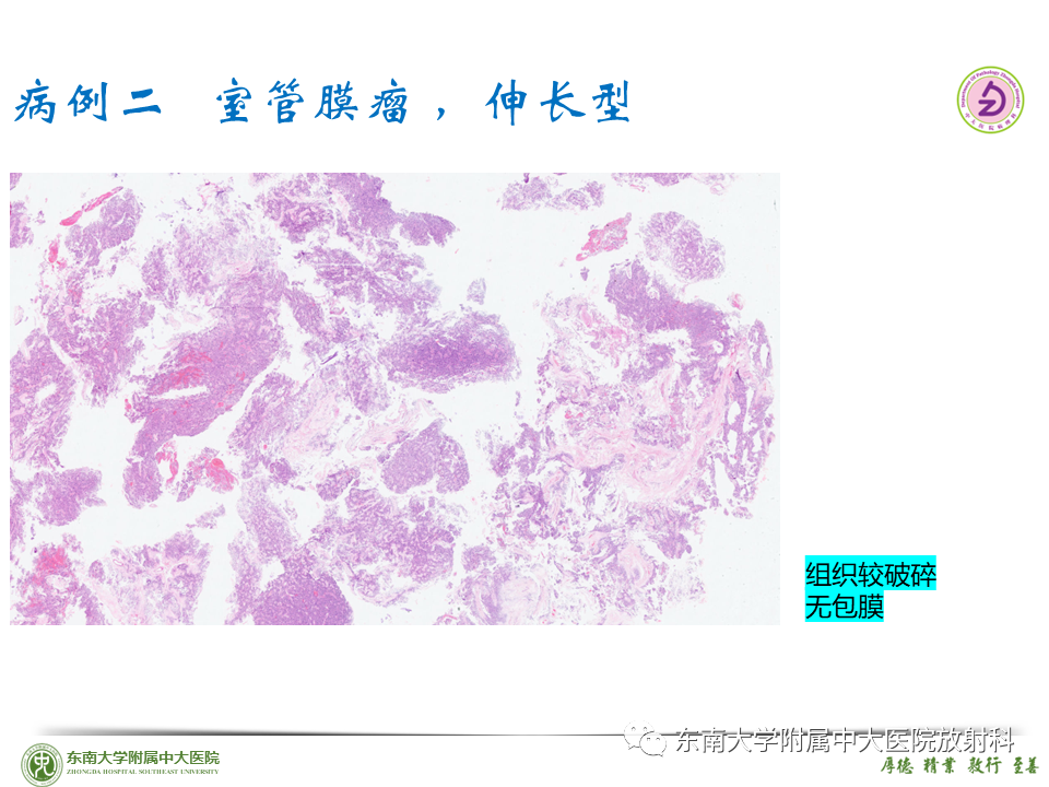 影像PPT - 【PPT】脊髓室管膜瘤-28 影像PPT - 【PPT】脊髓室管膜瘤-28