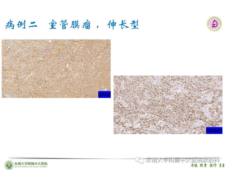 影像PPT - 【PPT】脊髓室管膜瘤-31 影像PPT - 【PPT】脊髓室管膜瘤-31