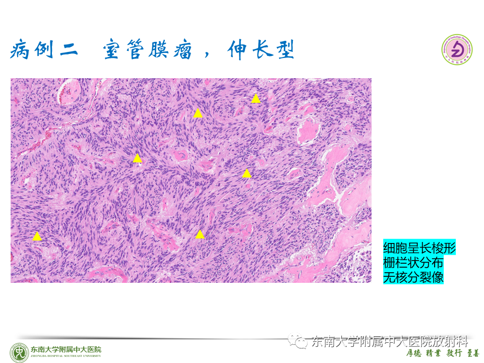 影像PPT - 【PPT】脊髓室管膜瘤-30 影像PPT - 【PPT】脊髓室管膜瘤-30