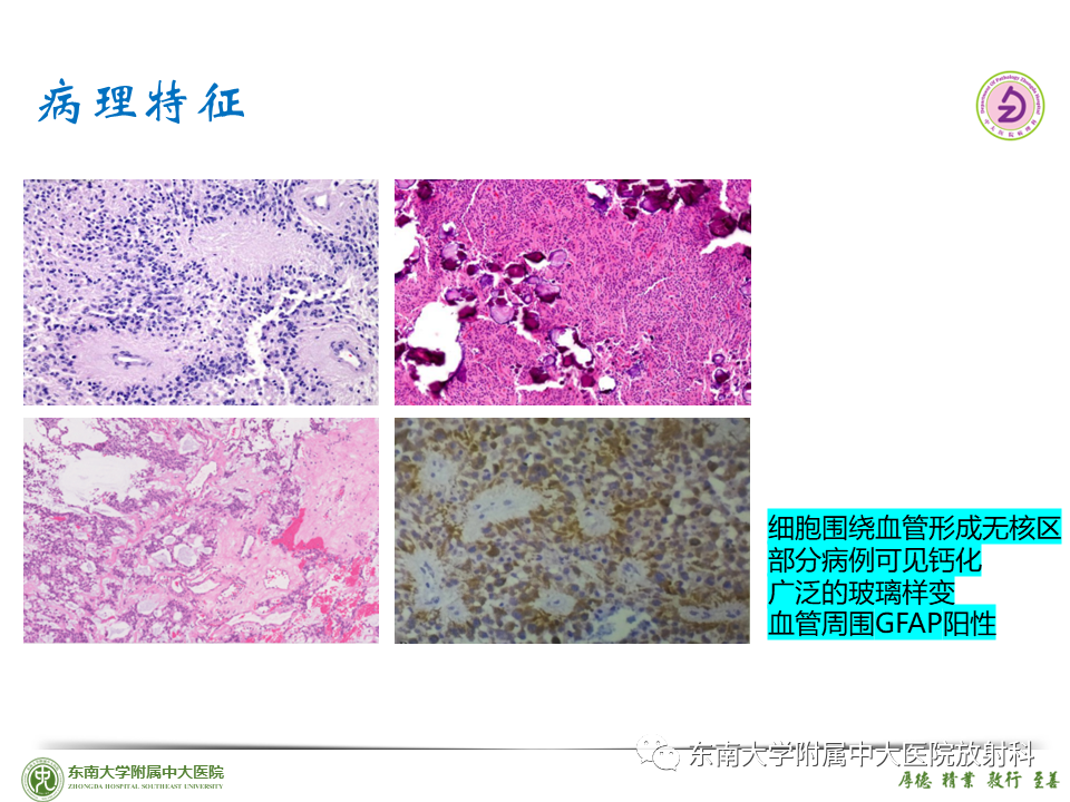 影像PPT - 【PPT】脊髓室管膜瘤-33 影像PPT - 【PPT】脊髓室管膜瘤-33