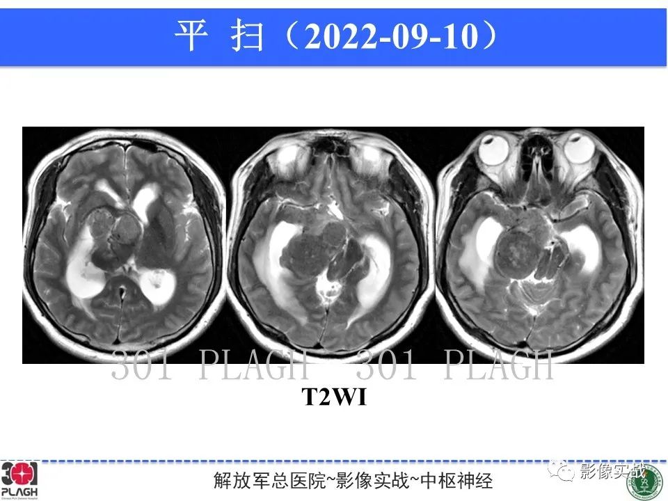 影像PPT - 【病例】鞍区孤立性纤维瘤1例CT及MR影像-5