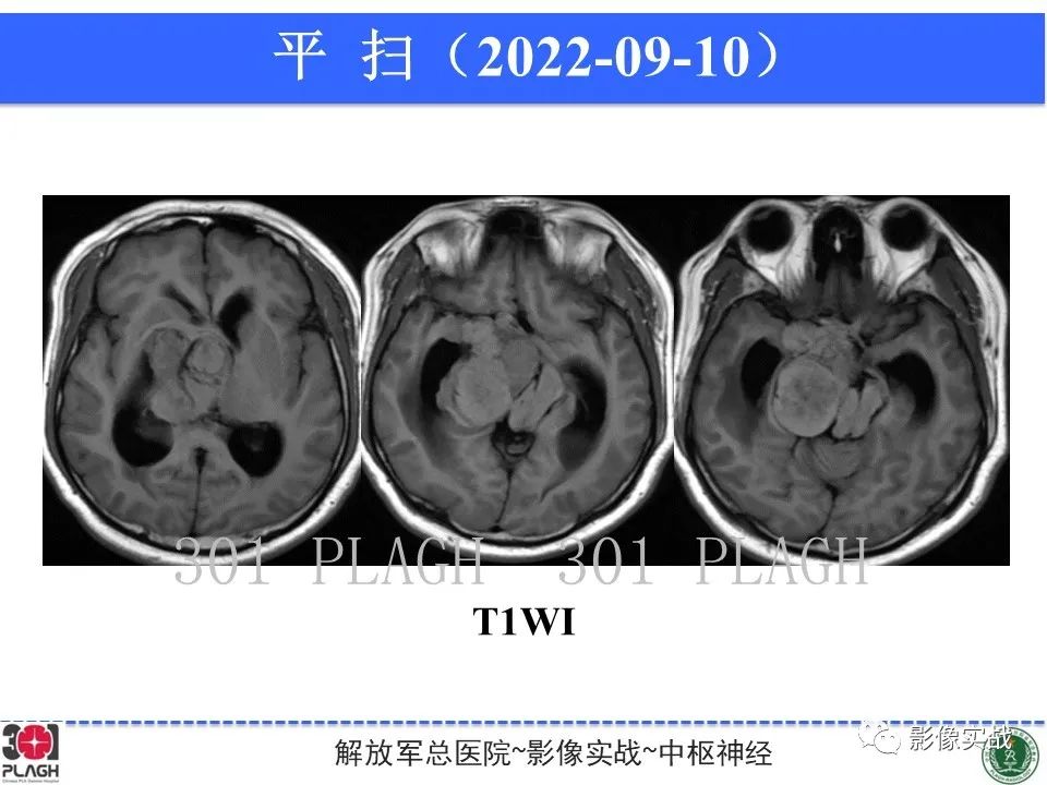 影像PPT - 【病例】鞍区孤立性纤维瘤1例CT及MR影像-6