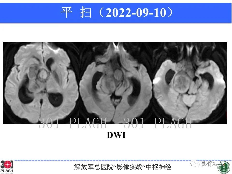 影像PPT - 【病例】鞍区孤立性纤维瘤1例CT及MR影像-7