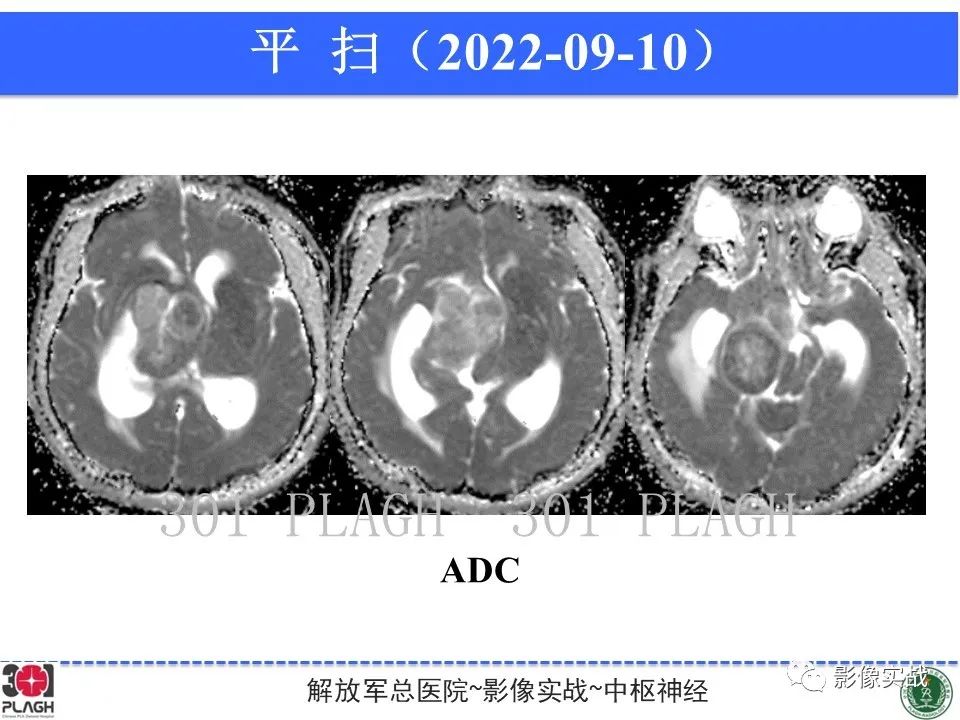 影像PPT - 【病例】鞍区孤立性纤维瘤1例CT及MR影像-8