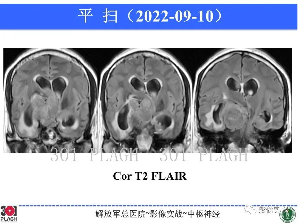 影像PPT - 【病例】鞍区孤立性纤维瘤1例CT及MR影像-9