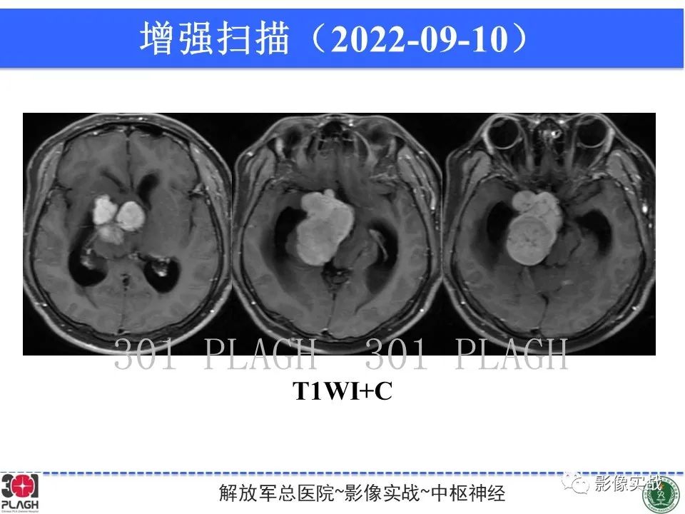 影像PPT - 【病例】鞍区孤立性纤维瘤1例CT及MR影像-10