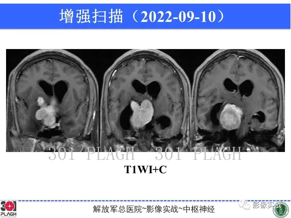 影像PPT - 【病例】鞍区孤立性纤维瘤1例CT及MR影像-11
