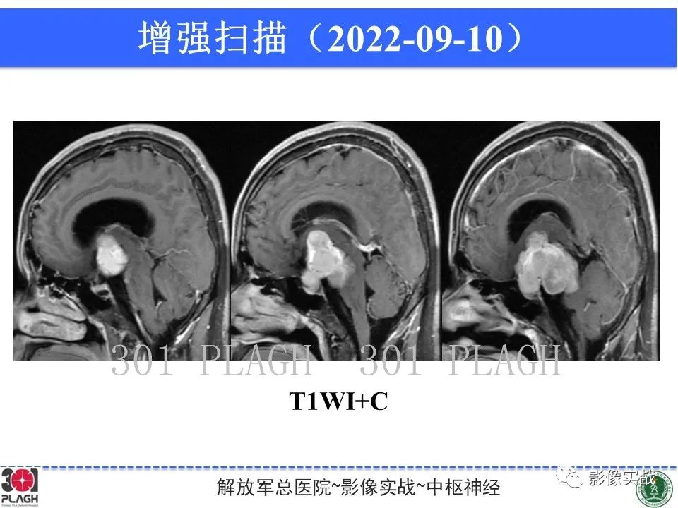 影像PPT - 【病例】鞍区孤立性纤维瘤1例CT及MR影像-12
