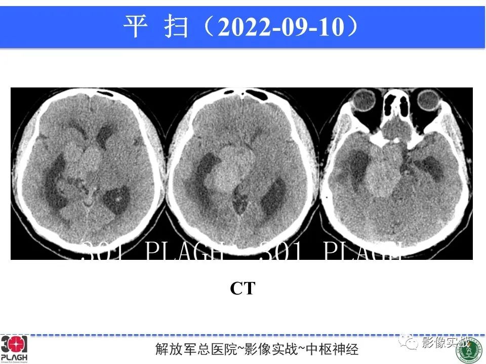 影像PPT - 【病例】鞍区孤立性纤维瘤1例CT及MR影像-13