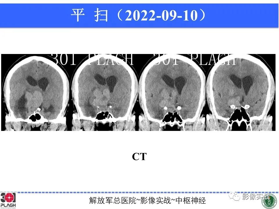 影像PPT - 【病例】鞍区孤立性纤维瘤1例CT及MR影像-14