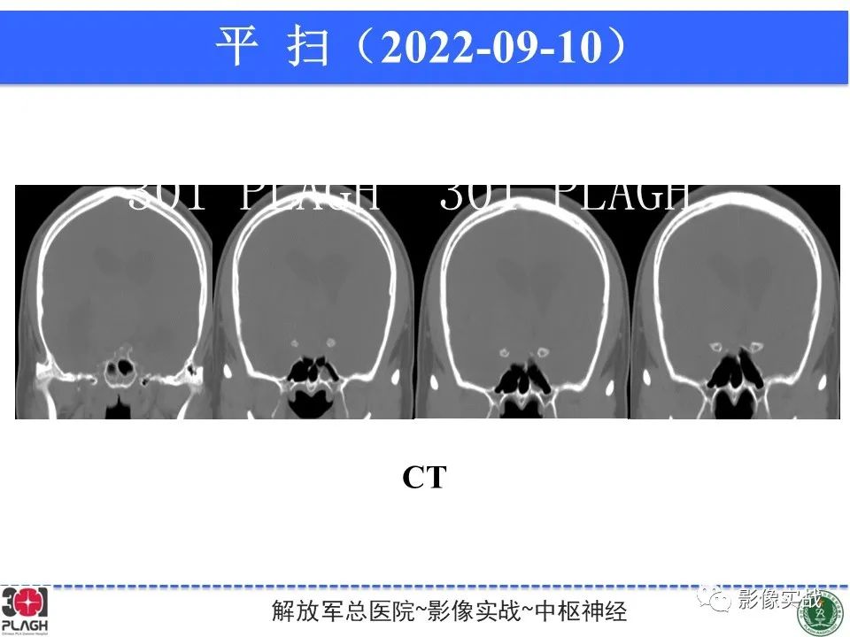 影像PPT - 【病例】鞍区孤立性纤维瘤1例CT及MR影像-15