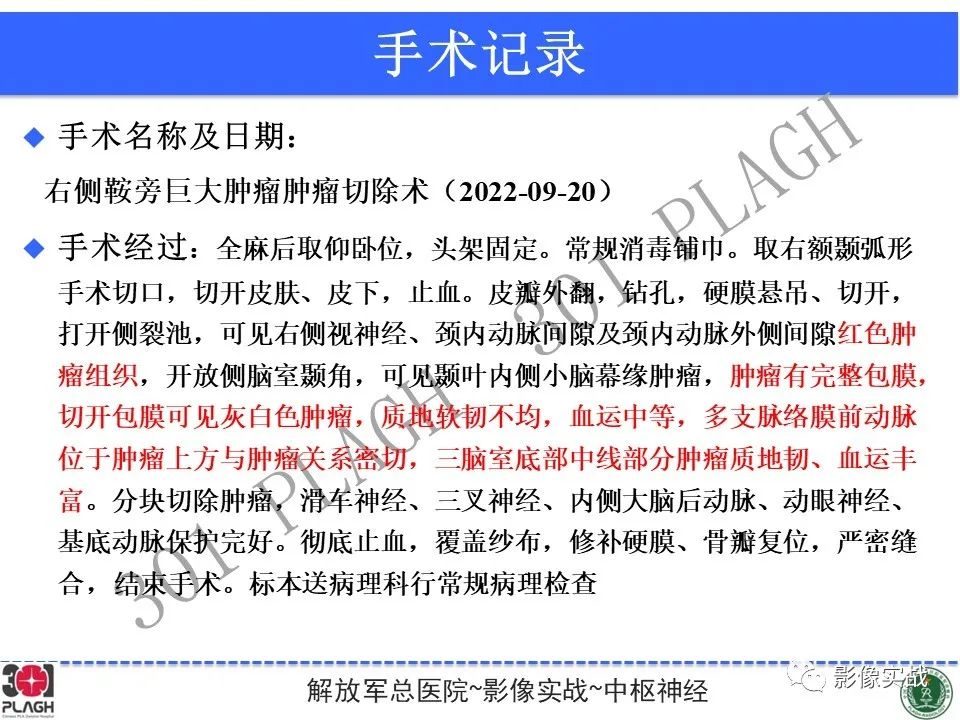 影像PPT - 【病例】鞍区孤立性纤维瘤1例CT及MR影像-22