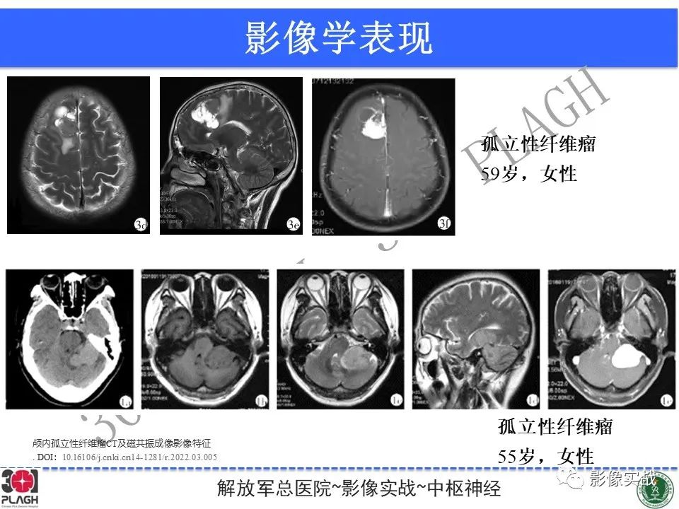 影像PPT - 【病例】鞍区孤立性纤维瘤1例CT及MR影像-27