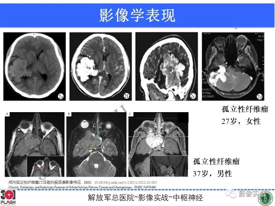 影像PPT - 【病例】鞍区孤立性纤维瘤1例CT及MR影像-28
