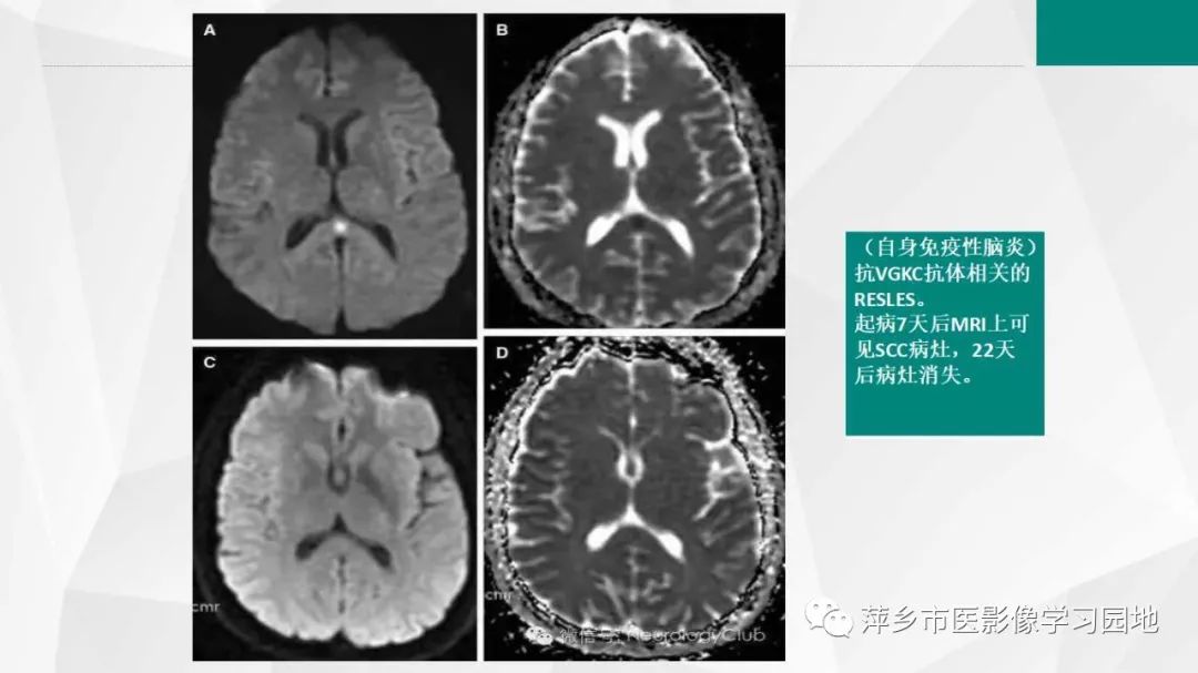 影像PPT - 【PPT】可逆性胼胝体压部病变综合征-19
