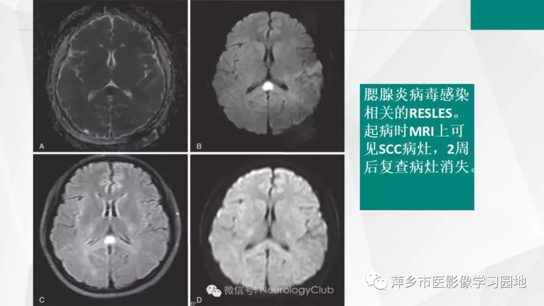 影像PPT - 【PPT】可逆性胼胝体压部病变综合征-20
