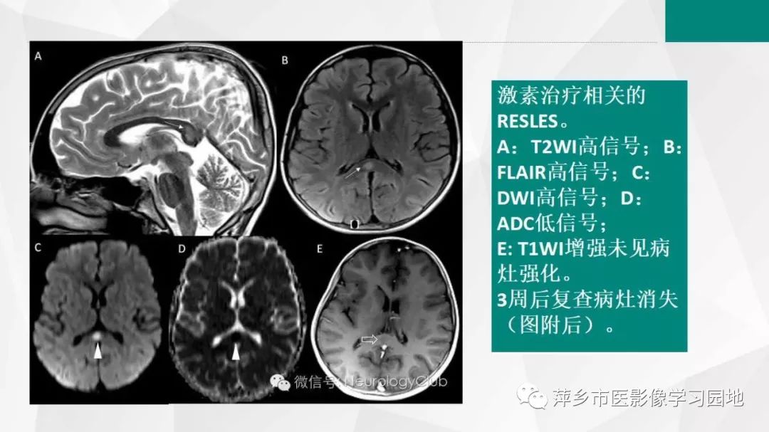 影像PPT - 【PPT】可逆性胼胝体压部病变综合征-21