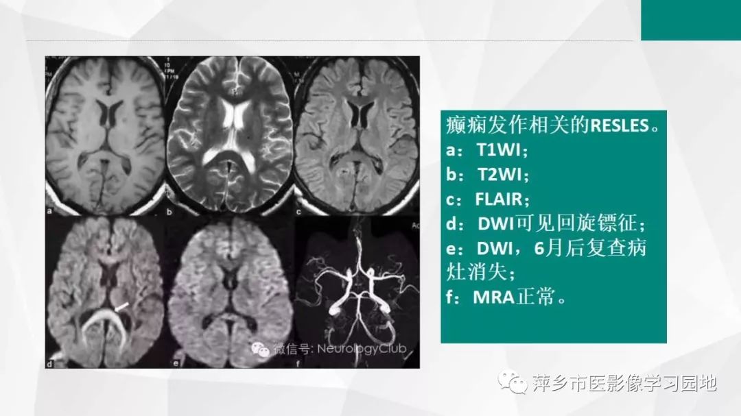 影像PPT - 【PPT】可逆性胼胝体压部病变综合征-23