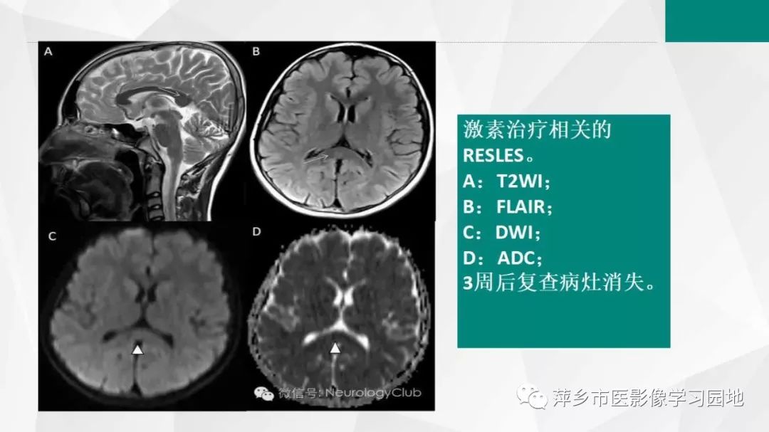 影像PPT - 【PPT】可逆性胼胝体压部病变综合征-22