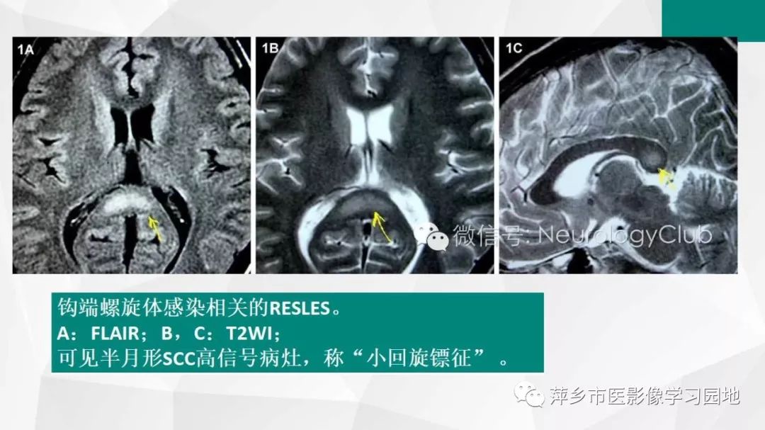 影像PPT - 【PPT】可逆性胼胝体压部病变综合征-24