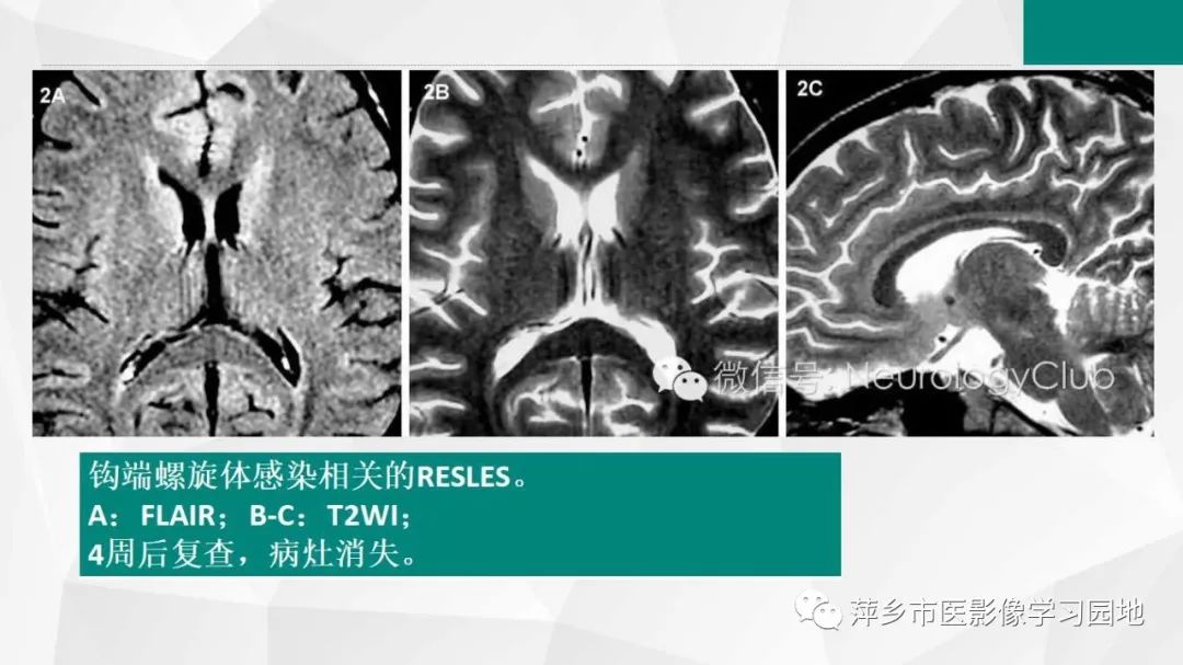 影像PPT - 【PPT】可逆性胼胝体压部病变综合征-25