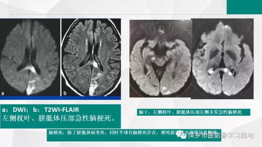 影像PPT - 【PPT】可逆性胼胝体压部病变综合征-27