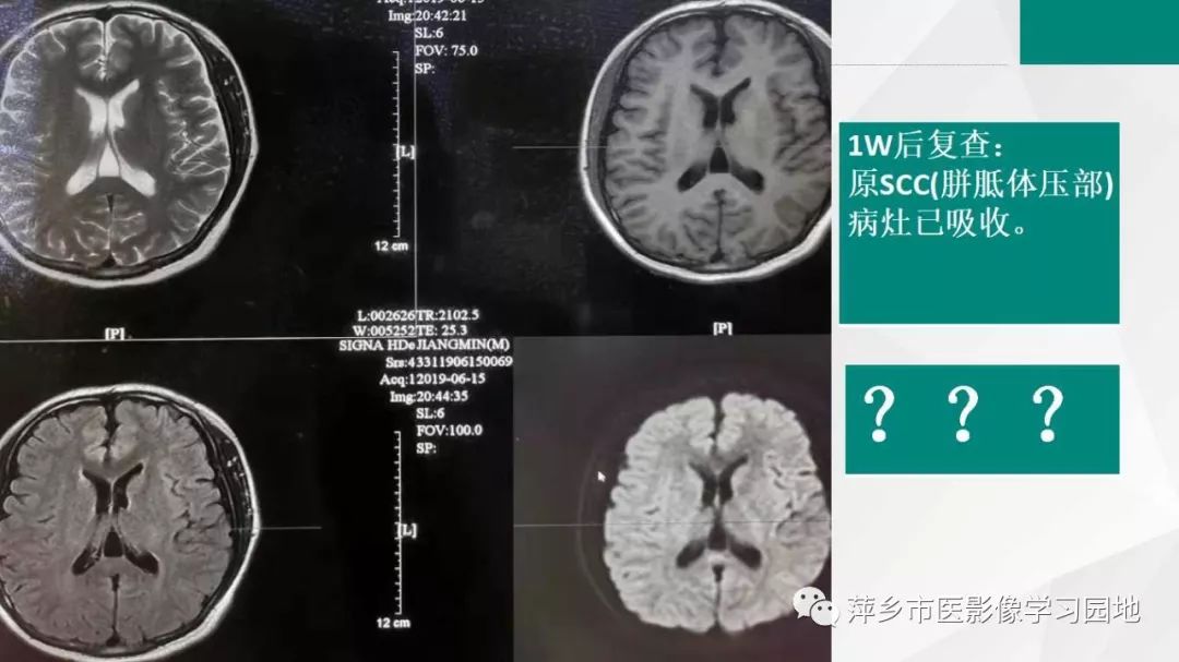 影像PPT - 【PPT】可逆性胼胝体压部病变综合征-29