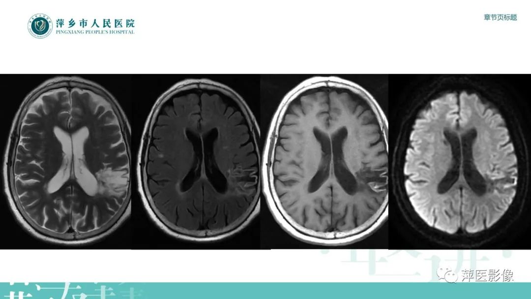 影像PPT - 【PPT】脑皮质层状坏死的影像诊断-5